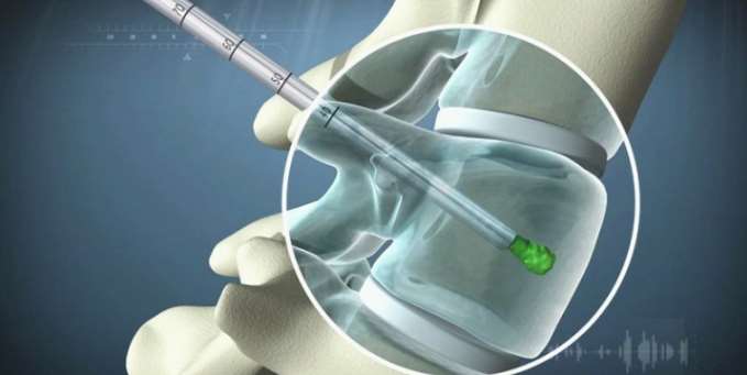 医疗器械三维动画制作效果图