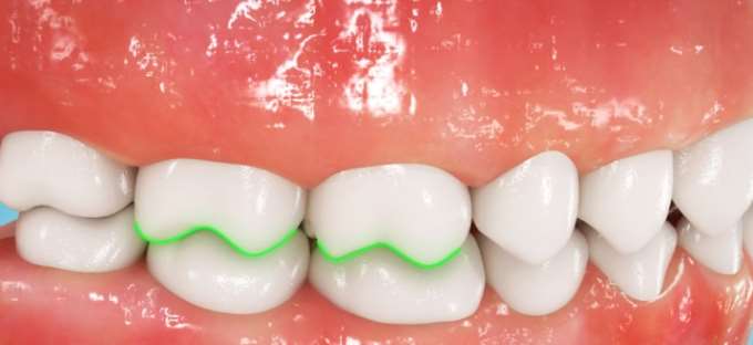 牙齿矫正三维动画制作